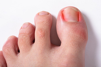 ingrown toenail