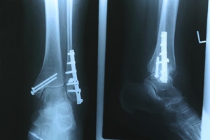Jon Gray Suffers Stress Fracture in Left Foot