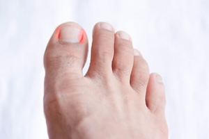 Children, Toe Pain, and Ingrown Toenails