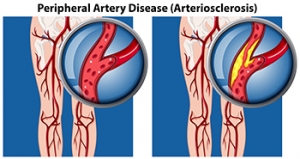 Risk Factors and Symptoms of PAD