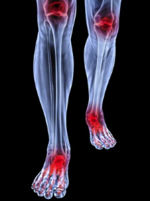 Study Shows Exercise May Help Arthritis
