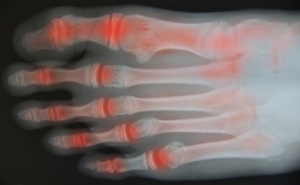 Assistive Devices for Foot or Ankle Arthritis