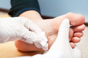 How and Where Plantar Warts Occur