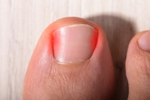 Ballet Dancers And Ingrown Toenails