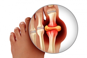 Why Does Gout Affect the Big Toe?