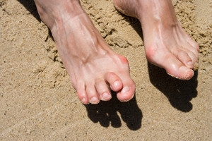 Reasons Hammertoe Can Develop
