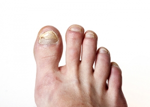 Elderly Toenail Fungus