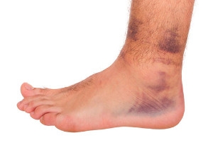 Giants Player Odell Beckham Suffers Ankle Sprain
