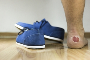 Shoes, Socks, and Blisters