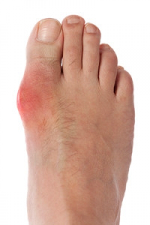 Decreasing Gout Risk